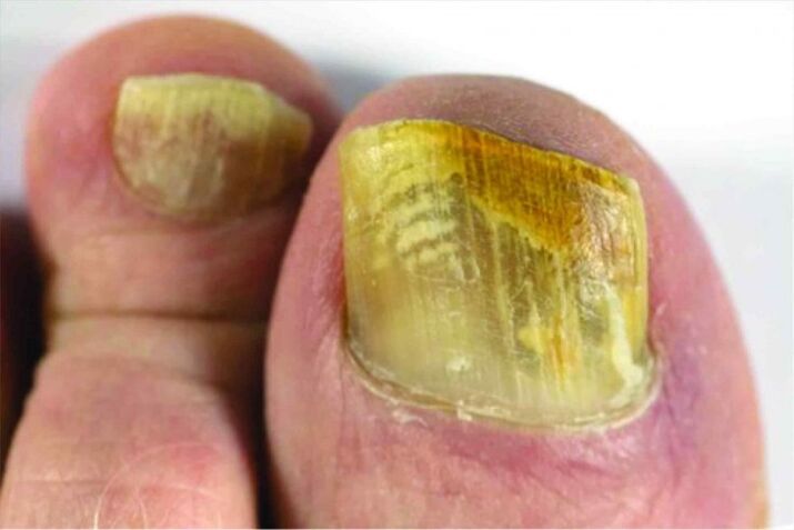 Nail
